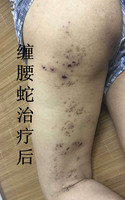 缠腰蛇火丹毒蜘蛛疮卓远福